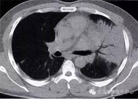 真菌|肺部炎症的“七大”常见CT表现