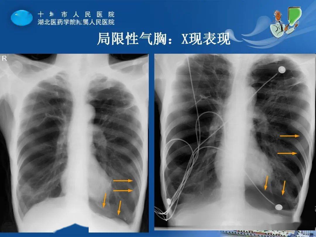 胸膜炎x线表现图片
