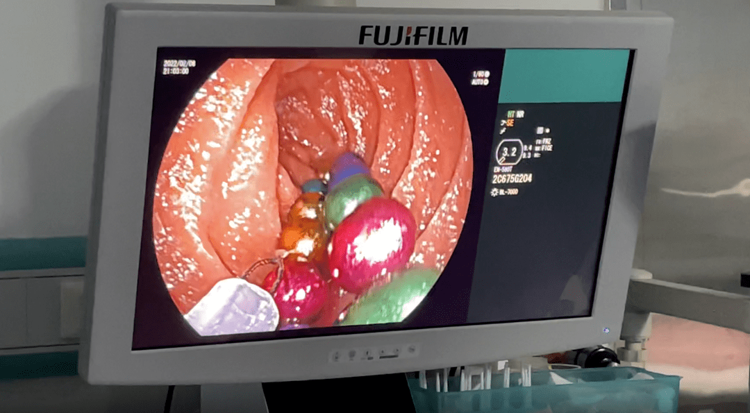 惊险5岁男童不慎吞11颗磁力珠医生小肠镜下及时取出