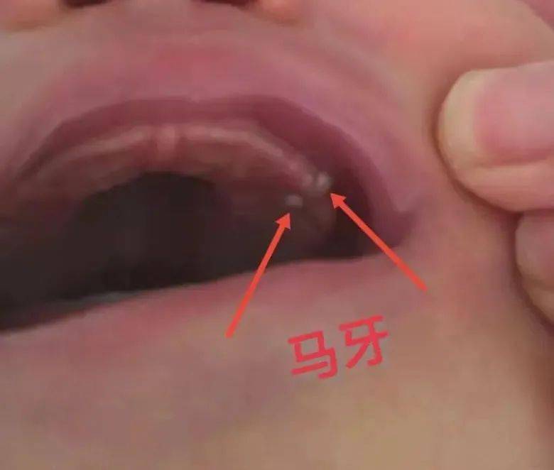 马牙有称为上皮珠,新生儿出生时, 有时在牙龈上可见针头大小的