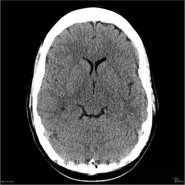 能在这例头颅ct上发现病变的都是高手