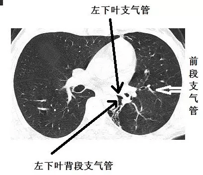 左肺下叶后基底段图片图片