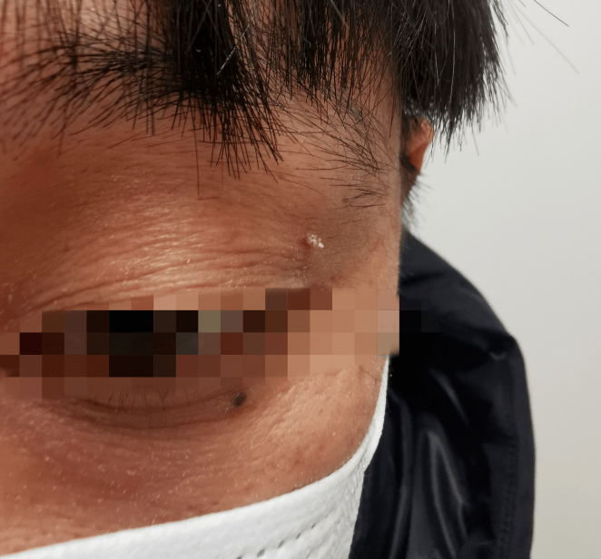 脖子上长了小疙瘩竟是这种病毒感染它不是专宠女性吗