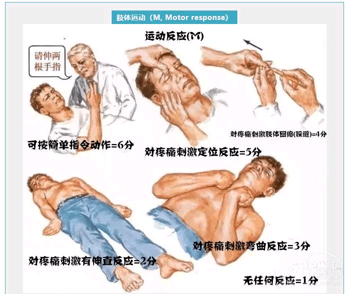 脑膜刺激征图片图片