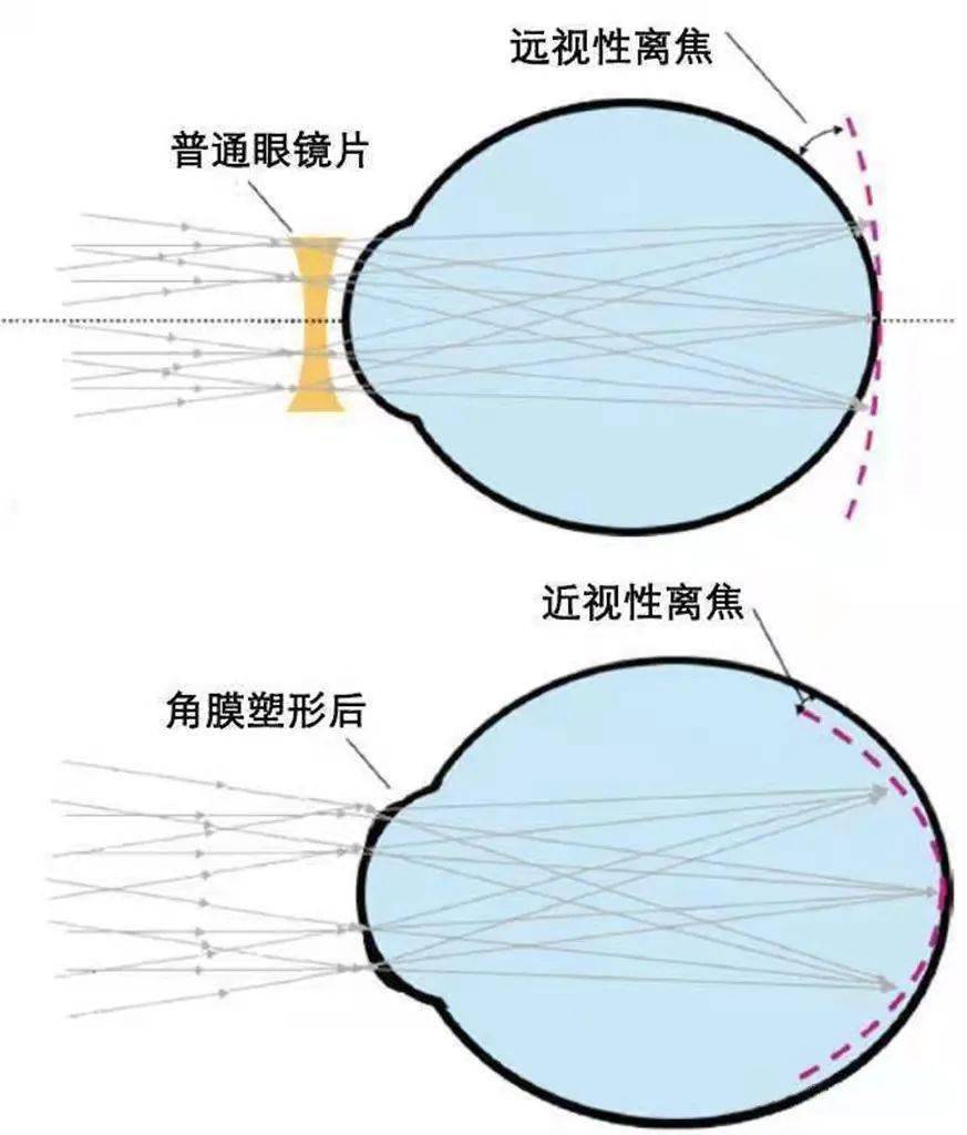 角膜塑形鏡是近視患者配戴的一種特殊的硬性角膜接觸鏡,它巧妙地採用