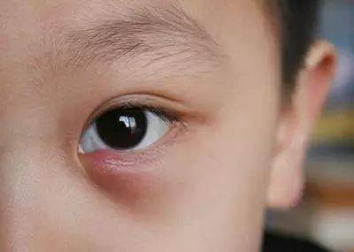 麦粒肿:如何避免及最佳治疗策略_眼睛_肿块_眼镜