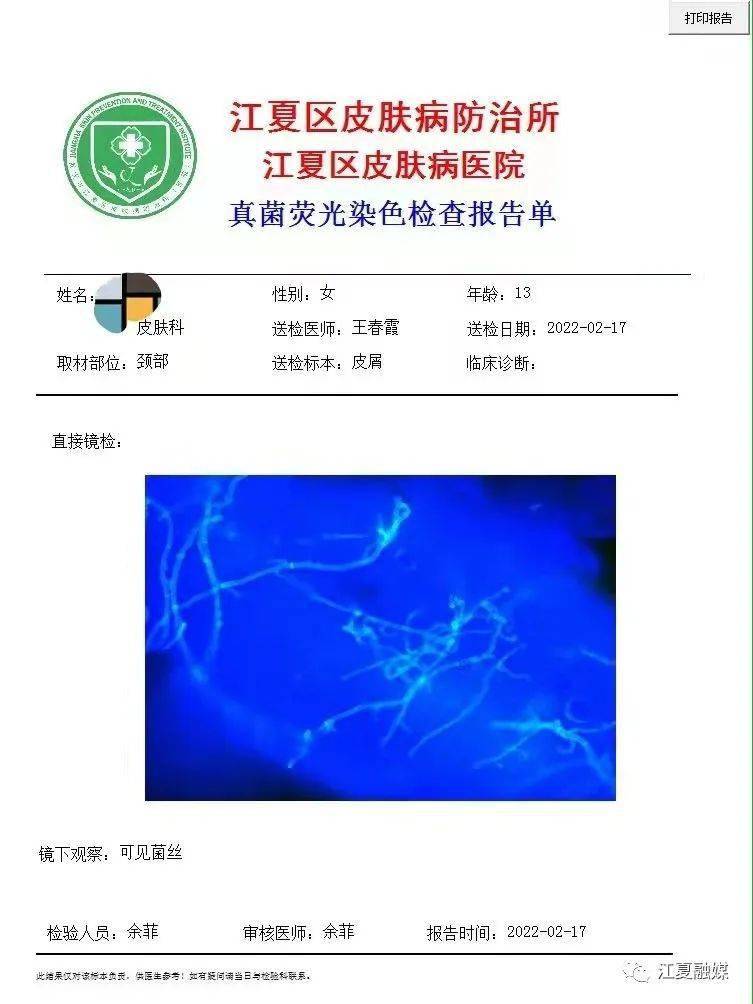 治疗_防治所_鳞屑