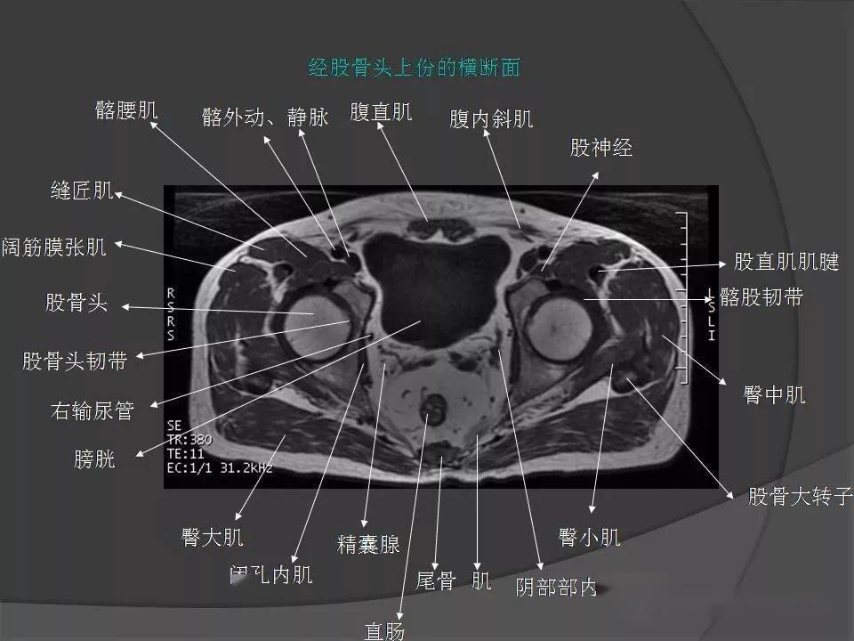 骨盆肌肉解剖mri標識