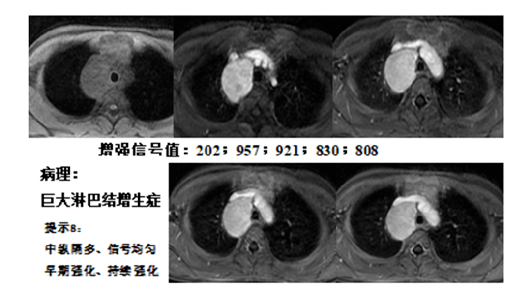 李智勇教授:见微知著-纵隔病变的mri成像_诊断_肿瘤_神经