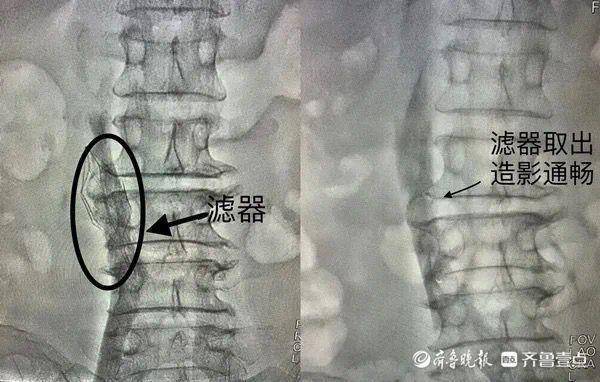 治疗|聊城市中医医院介入科成功完成一例下腔静脉滤器植入+取出术