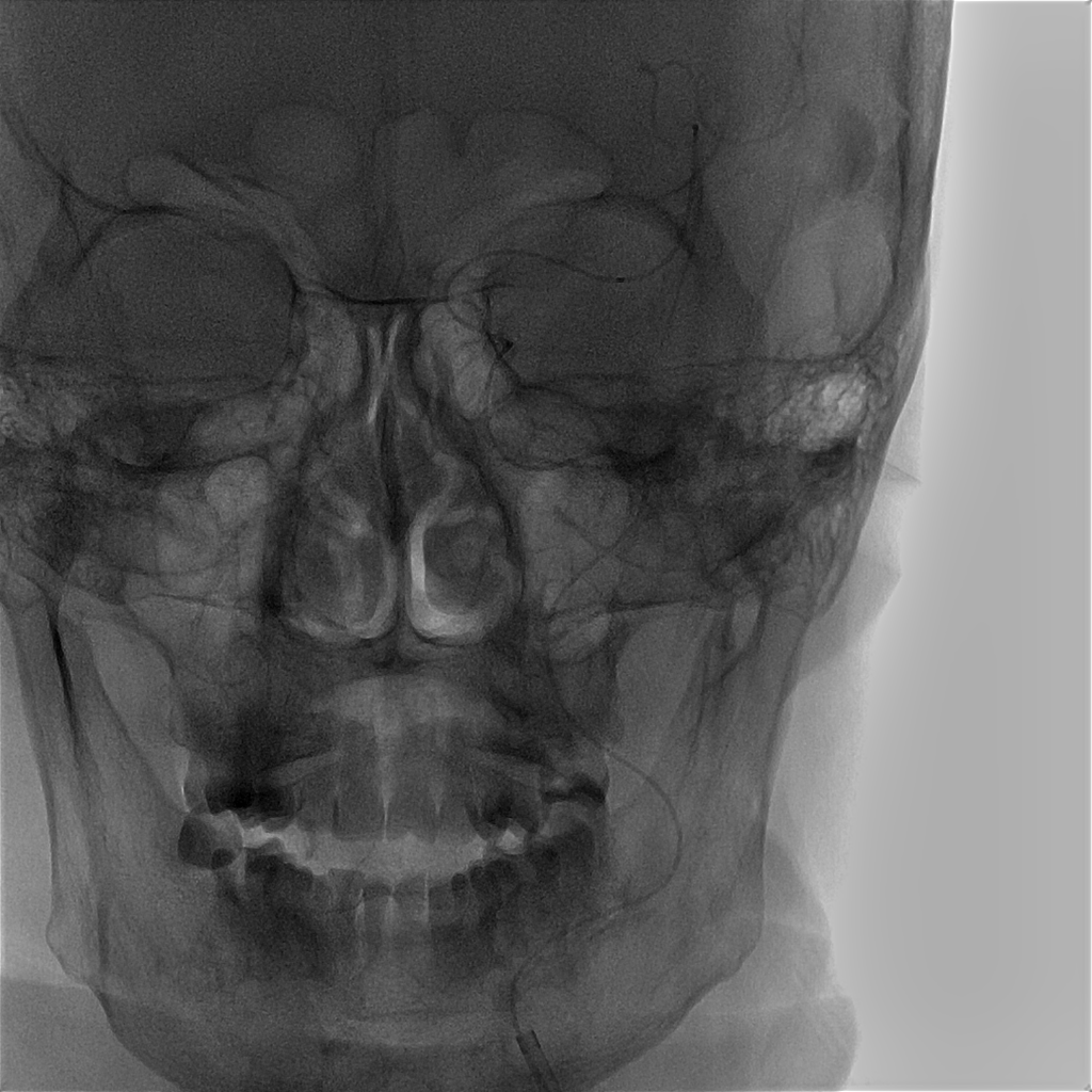 卒中美学馆丨ais洞鉴前循环串联病变铂金支架取栓一例