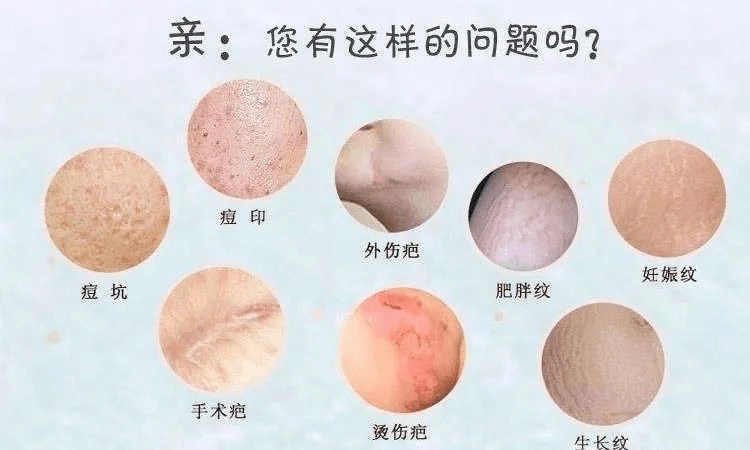 【新设备】神奇的疤痕橡皮擦_治疗仪_皮肤_点阵