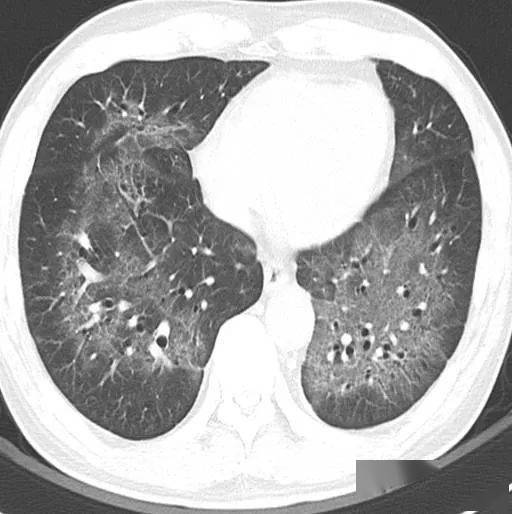 这个间质性肺炎还挺少见的