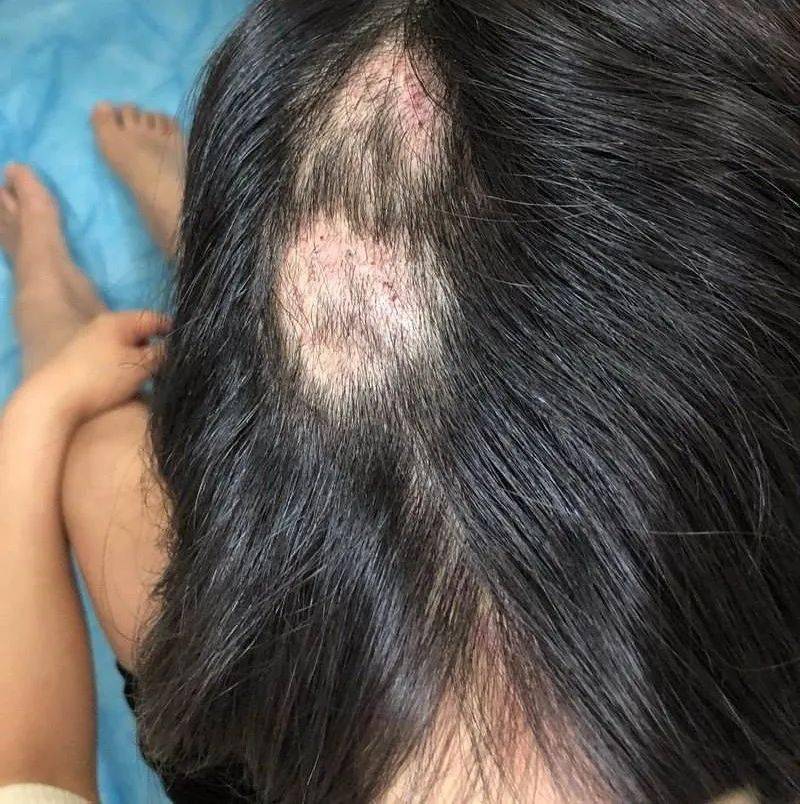 火针虽小作用大中医外治针功夫