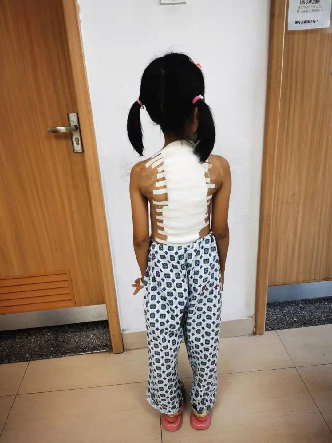 术前去年10月,该院脊柱外科接诊了一位脊柱侧弯伴驼背的9岁女孩