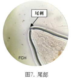 合并|一例分析 | 类风湿关节炎患者合并「钩虫感染」