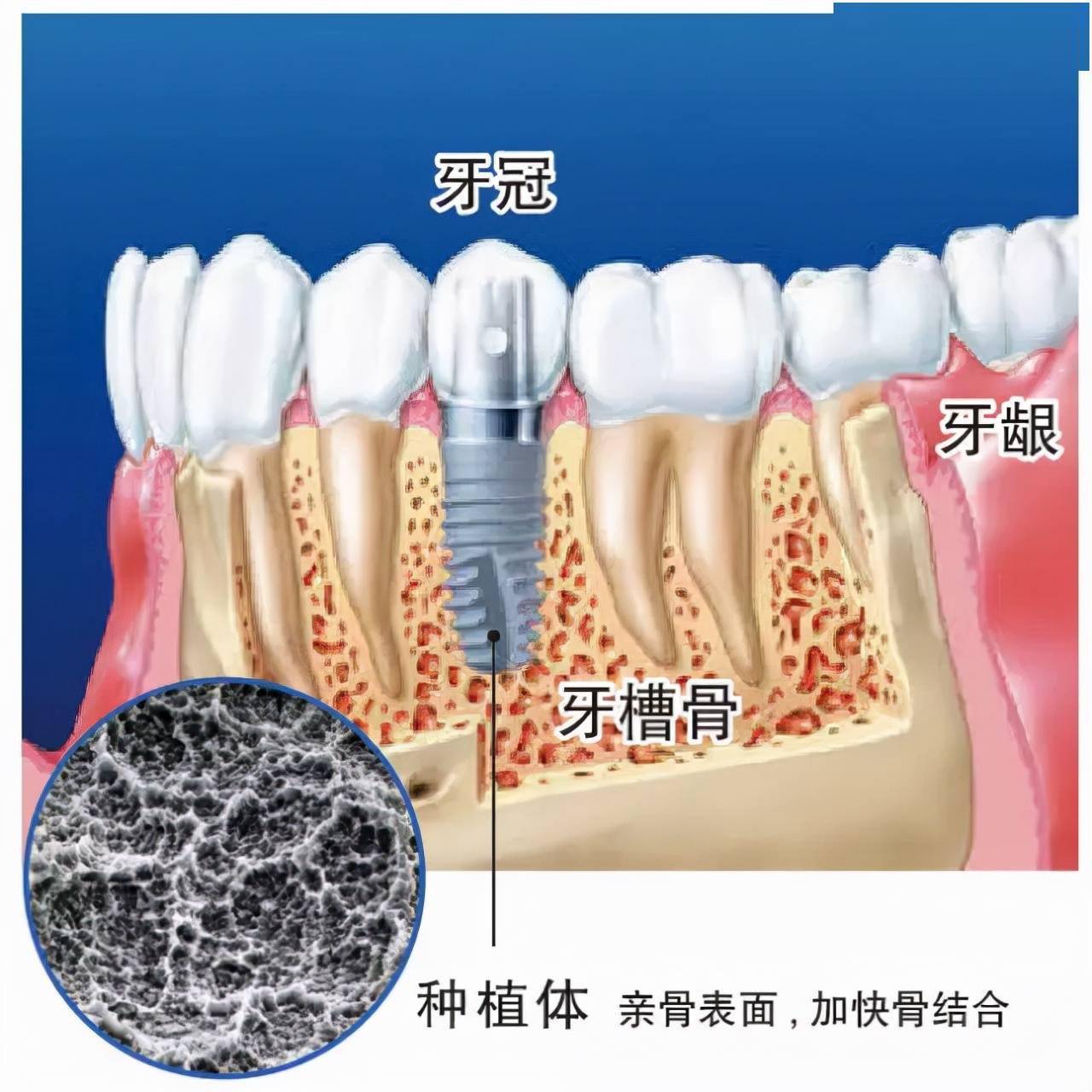 缺牙後如何修復2種主流修復方式口腔專家告訴你答案