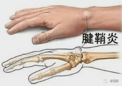 拇指腱鞘炎针刀示意图图片
