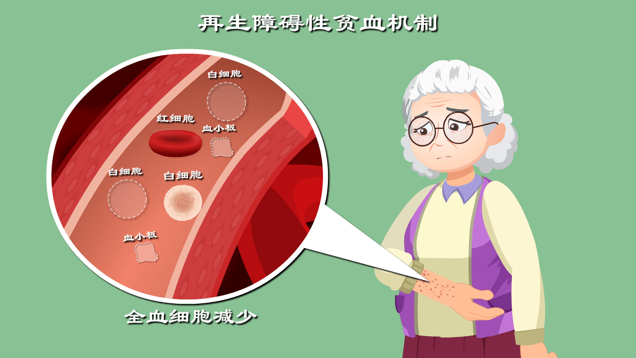 贫血出血不止全身感染一起来的恐怖疾病解密再生障碍性贫血