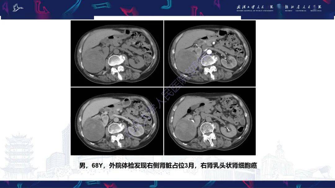 腎臟原發性尤文肉瘤影像診斷