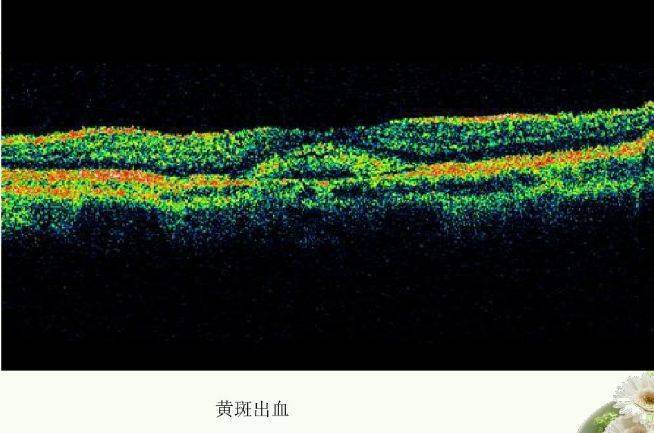 视网膜的层间结构,视网膜及其神经纤维层正常厚度变化