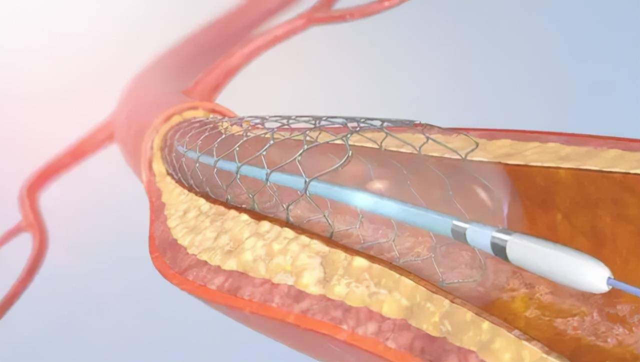 一场手术几万块心脏支架的寿命能有多少年再次堵塞还有救吗