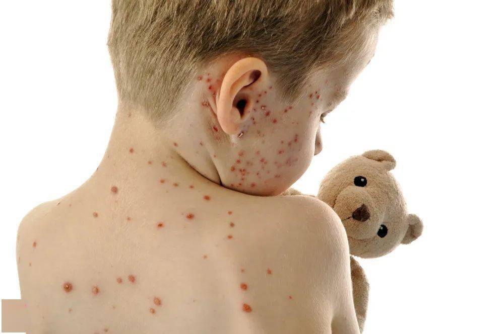 小孩出水痘的症状图片