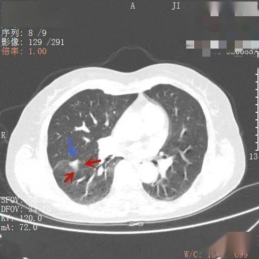 长毛刺的肺结节就一定良性吗