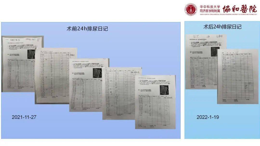 snm前后,24h排尿日记.