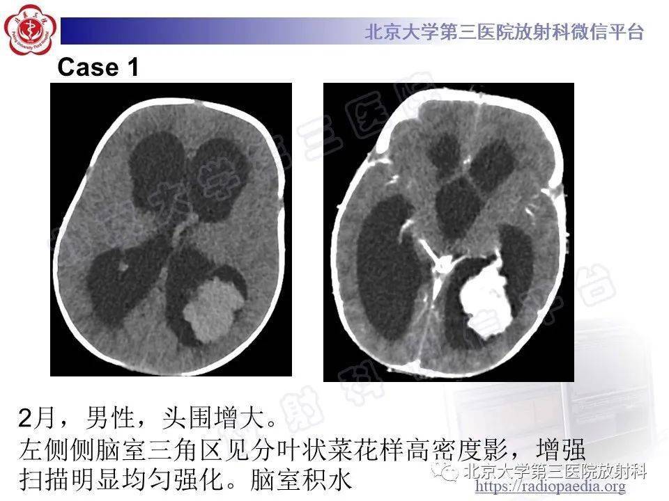 脑室内脑膜瘤影像表现