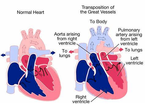 與肺動脈在解剖上互換位置,形成體循環與肺循環異常的一種先天性畸形