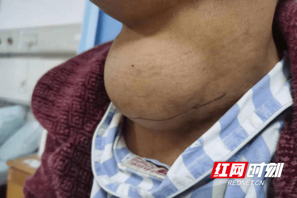 成功|永州市中心医院成功切除巨大甲状腺肿瘤