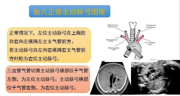 胎儿右锁骨下动脉迷走图片