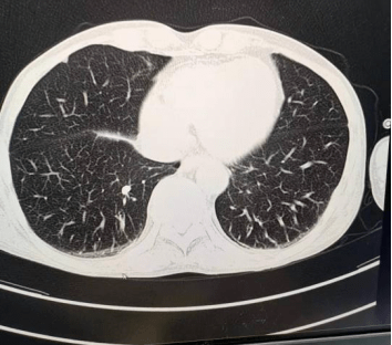 被類風溼關節炎糾纏多年後這位患者如何重獲新生例例聲輝