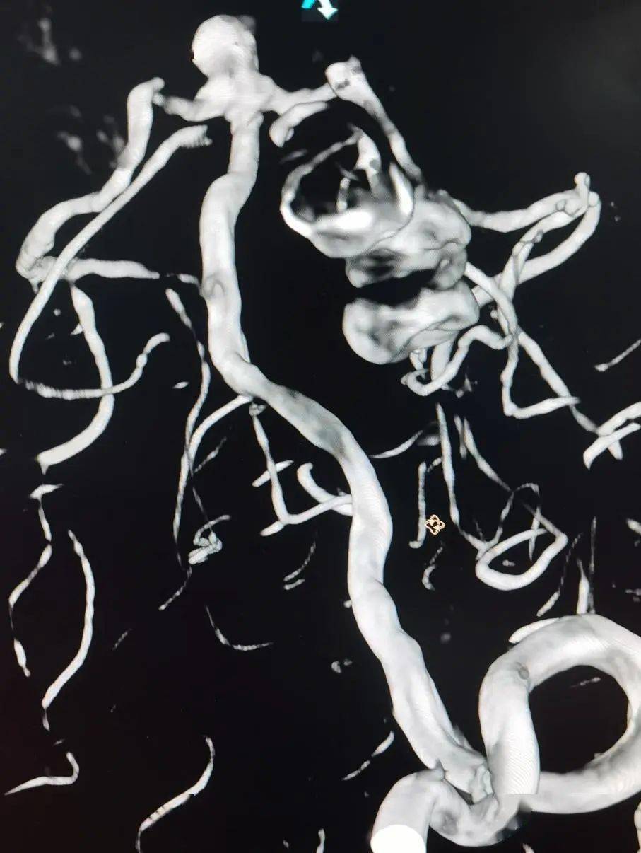 戴国栋jasper03ss弹簧圈联合tethys03中间导引导管在