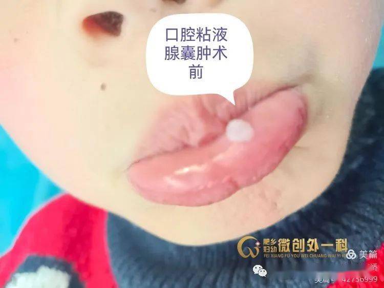 肥鄉區婦幼保健院外一科近日做的一例口腔粘液腺囊腫,術後即刻恢復,現