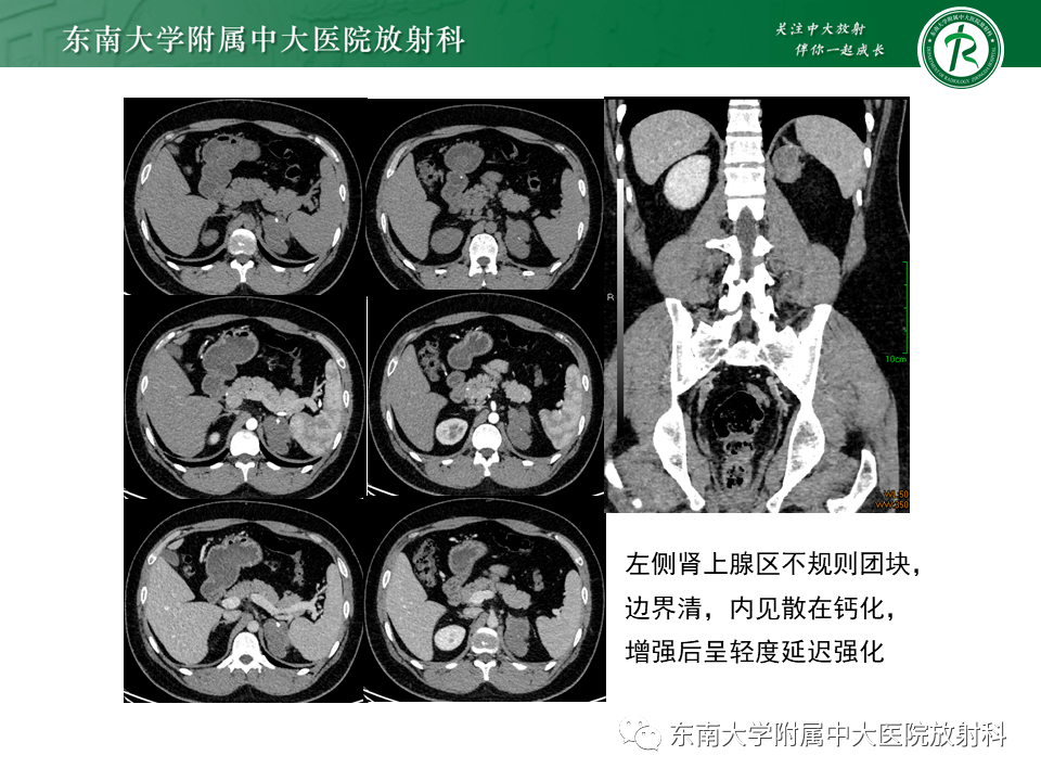 腎上腺神經源性腫瘤影像表現