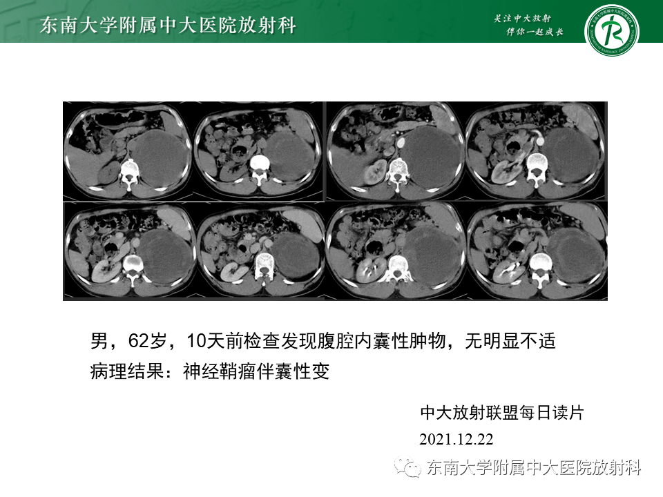 腎上腺神經源性腫瘤影像表現