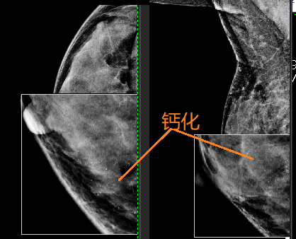 患者_治療_乳房