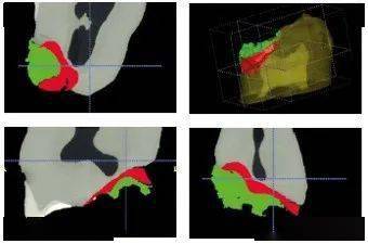 固美车针第五讲 树脂车针 操作 损伤 进行
