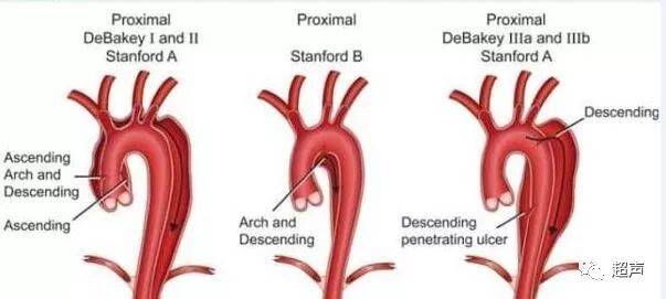 主動脈夾層的解剖分型
