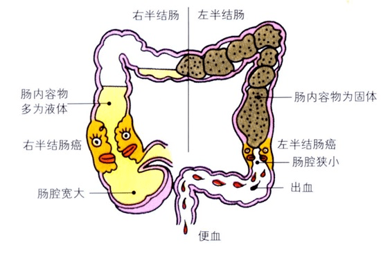 结肠癌位置图图片