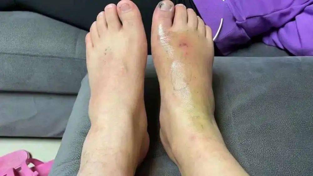 陕西一小伙右脚莫名麻木疼痛,险被截肢!