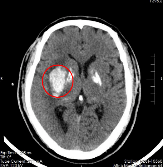 基底节区脑出血图片图片