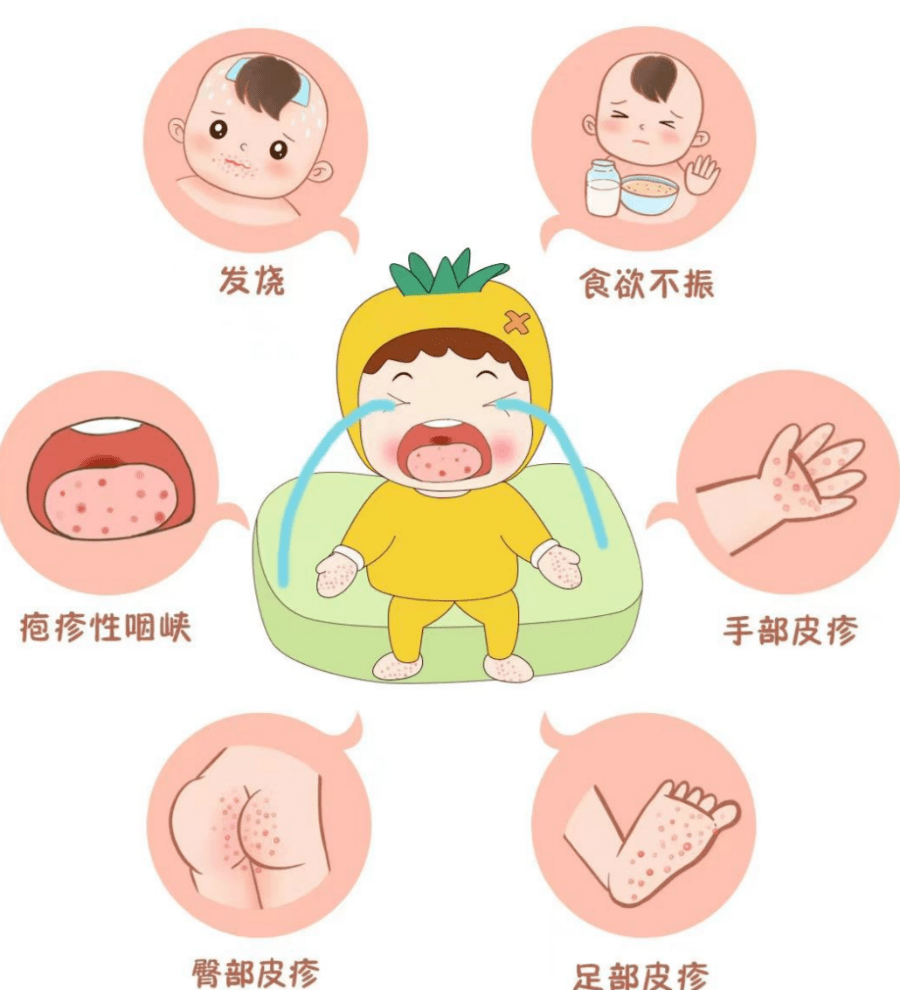 它来了 手足口病来势汹汹 传播 口腔 儿童 它来了 手足口病来势汹汹 传播 口腔 儿童