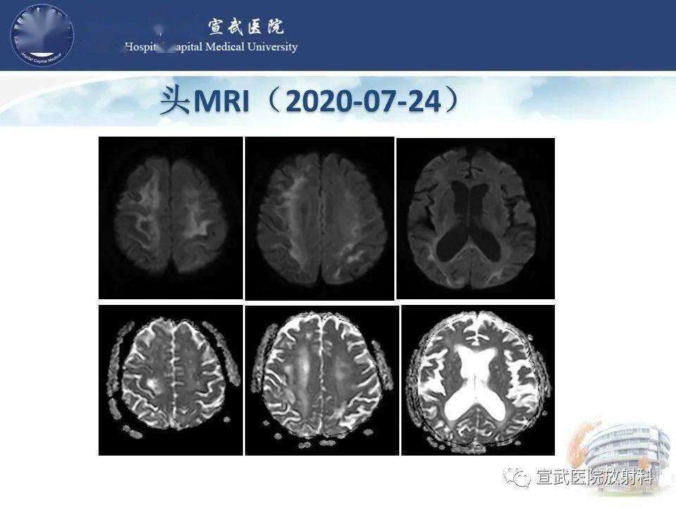 进行性多灶性白质脑病影像表现