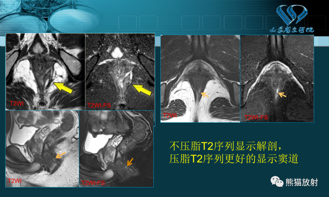 坐骨直肠窝CT图片