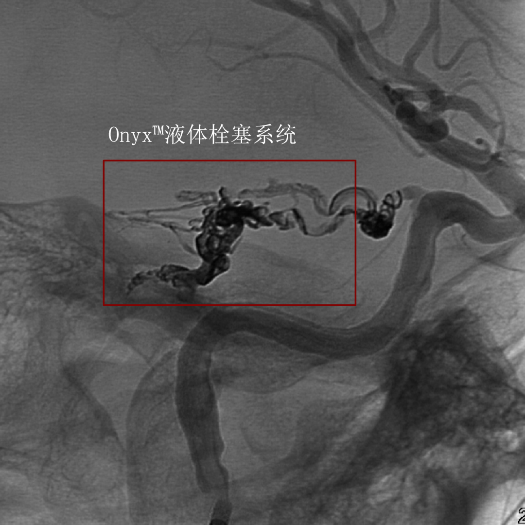 經腦膜垂體幹途徑栓塞小腦幕硬腦膜動靜脈瘻