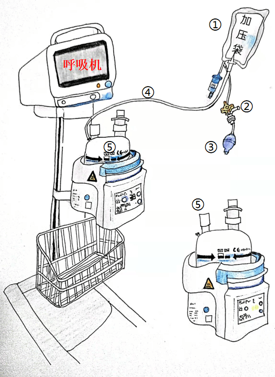 巧用輸液加壓袋為呼吸機加溼化水省時省力
