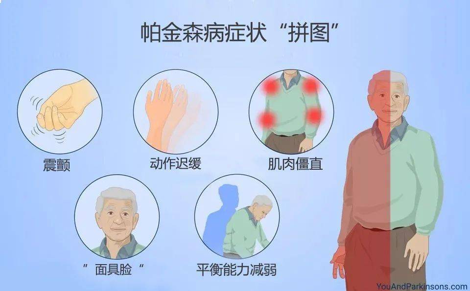 帕金森病有个迹象拼图医生推荐6个动作自测